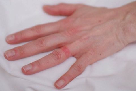 dermatitis on hand due to wedding ring